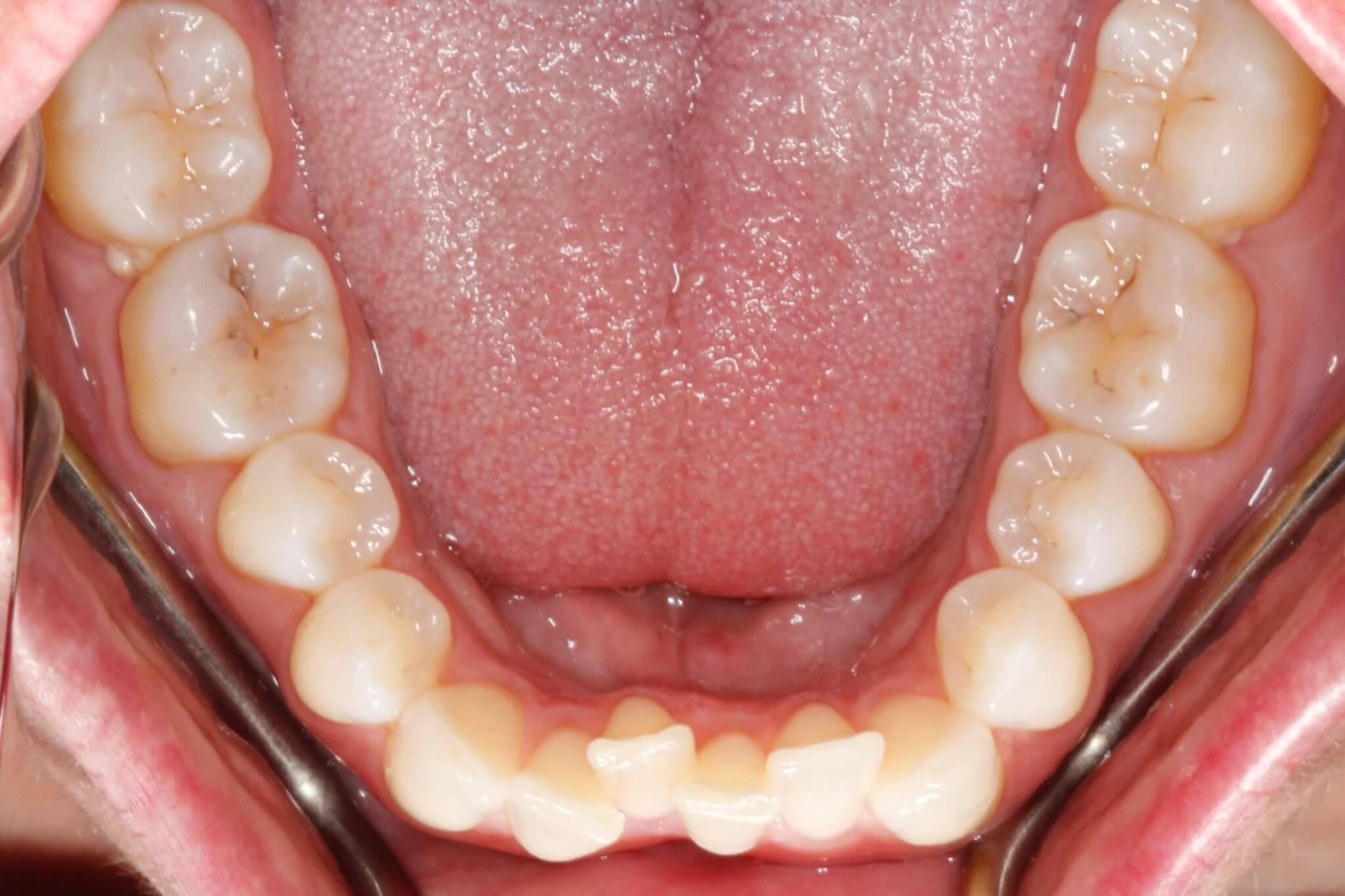 dental-crowding-before