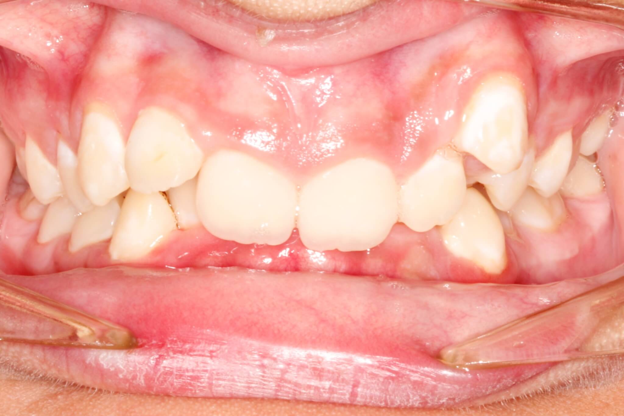 dental-crowding-before2