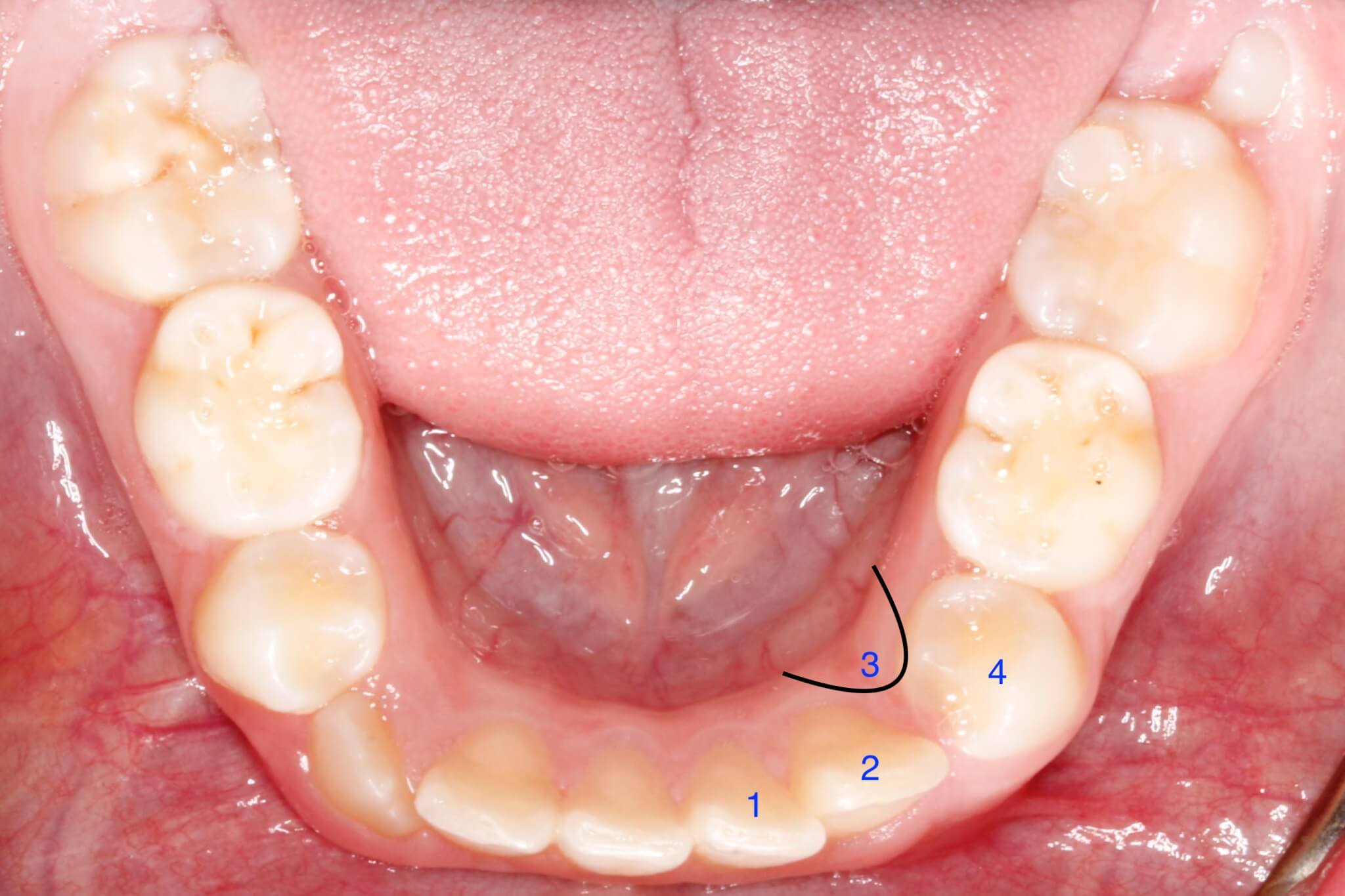 dental-crowding-before3