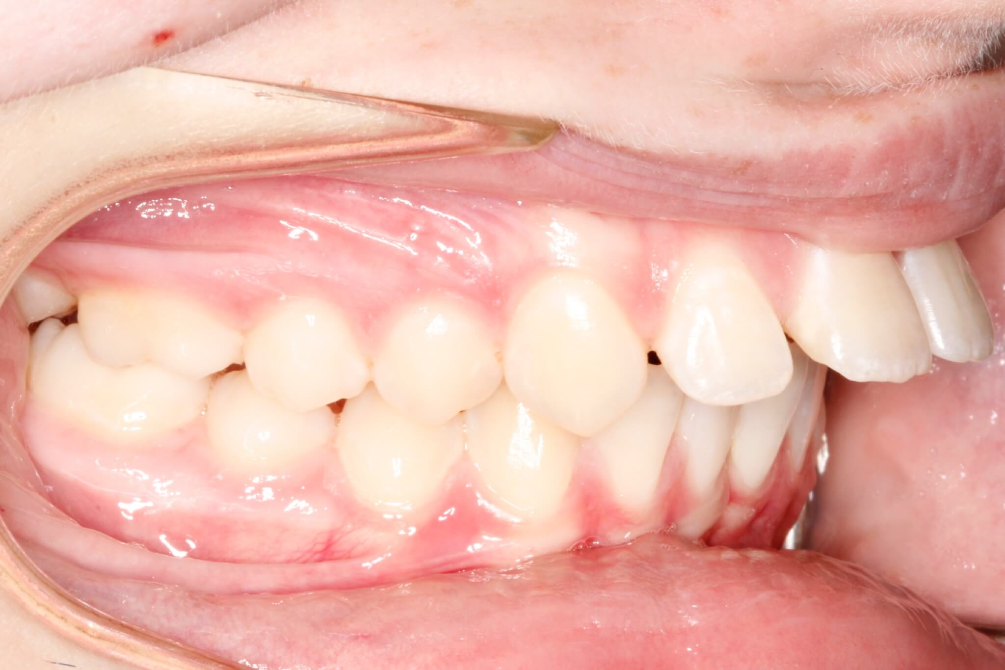 excess-overjet-before