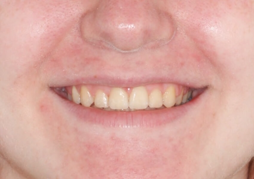 smile-after