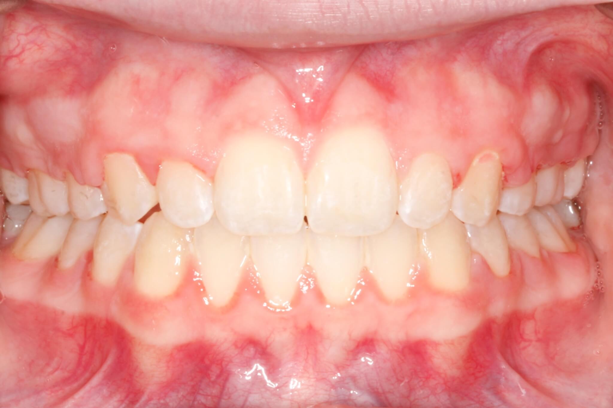 smile-after4