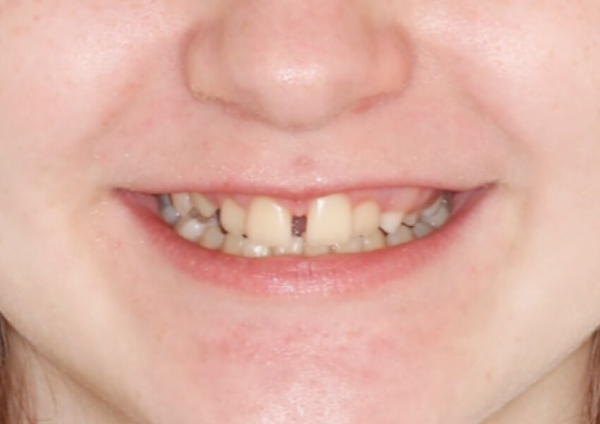 smile-before