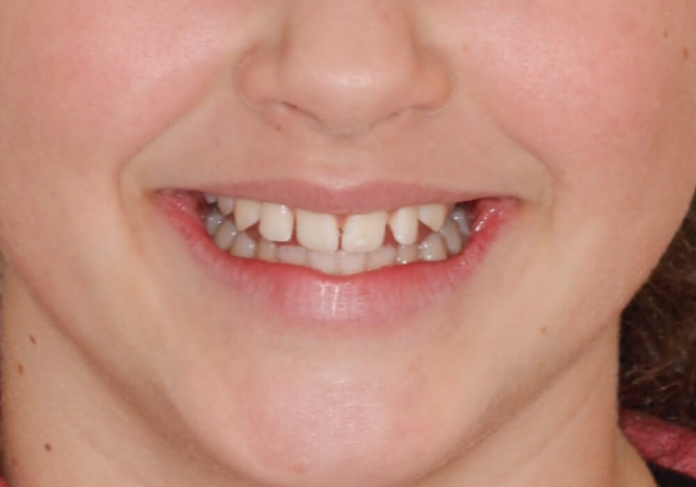 smile-before3
