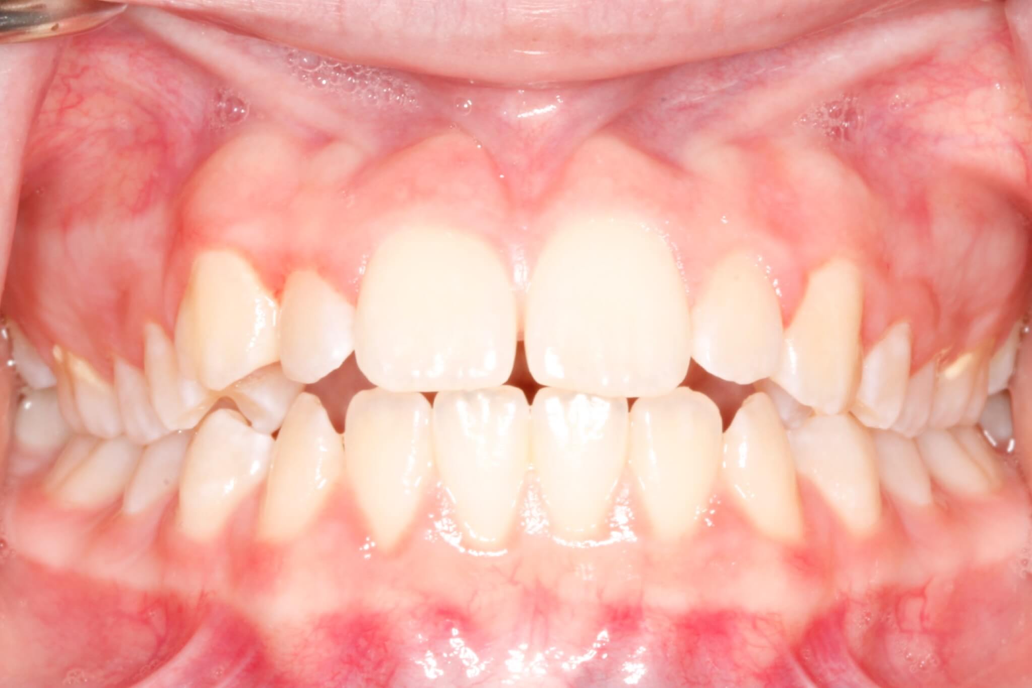 smile-before4