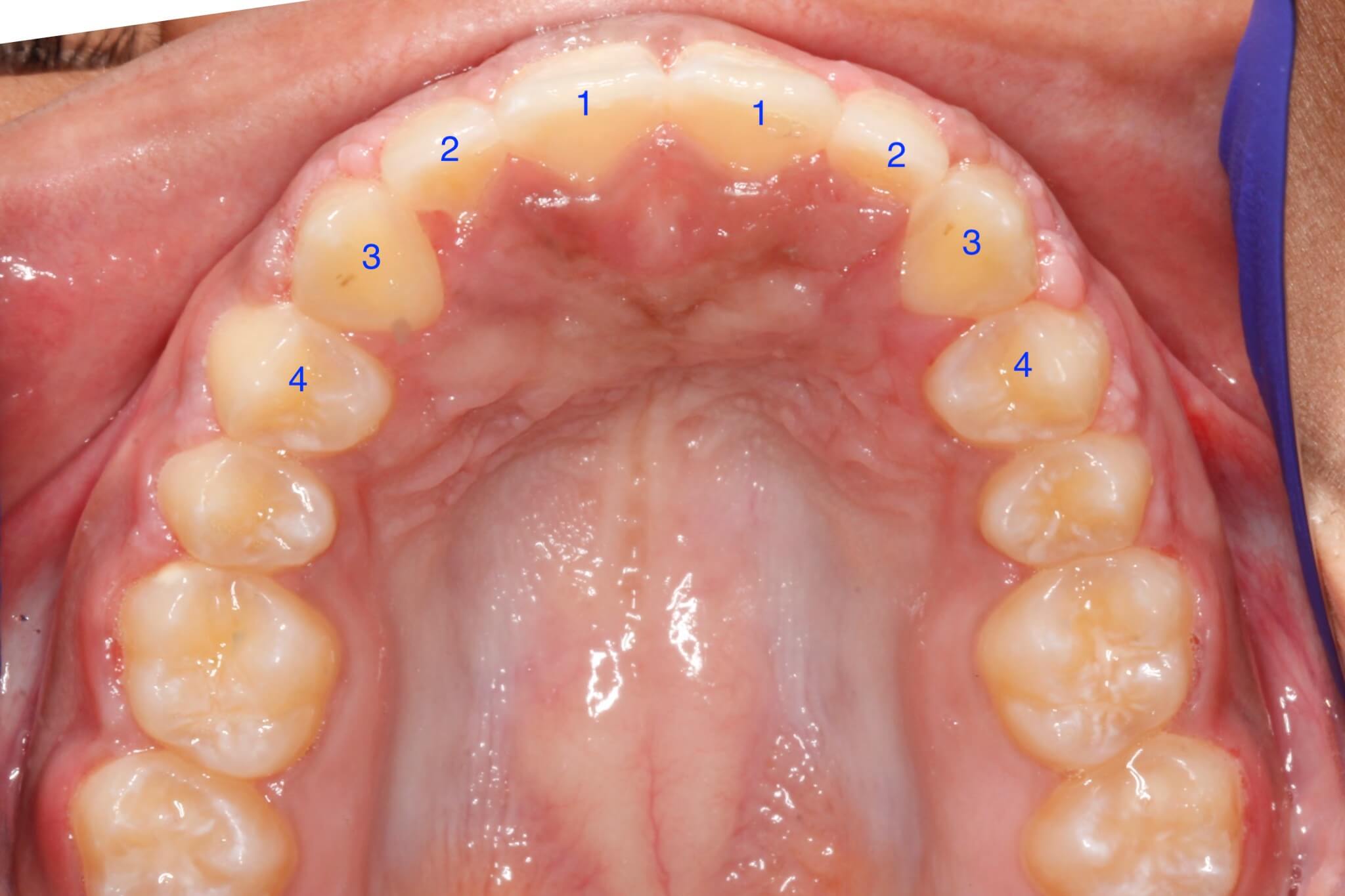 tooth-impactions-after3