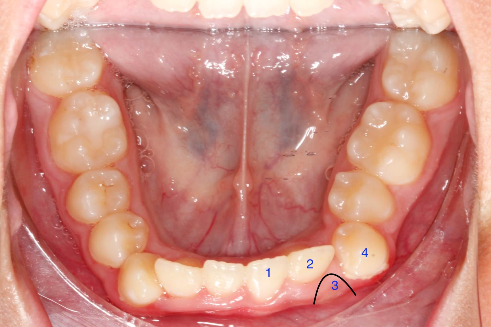 tooth-impactions-before