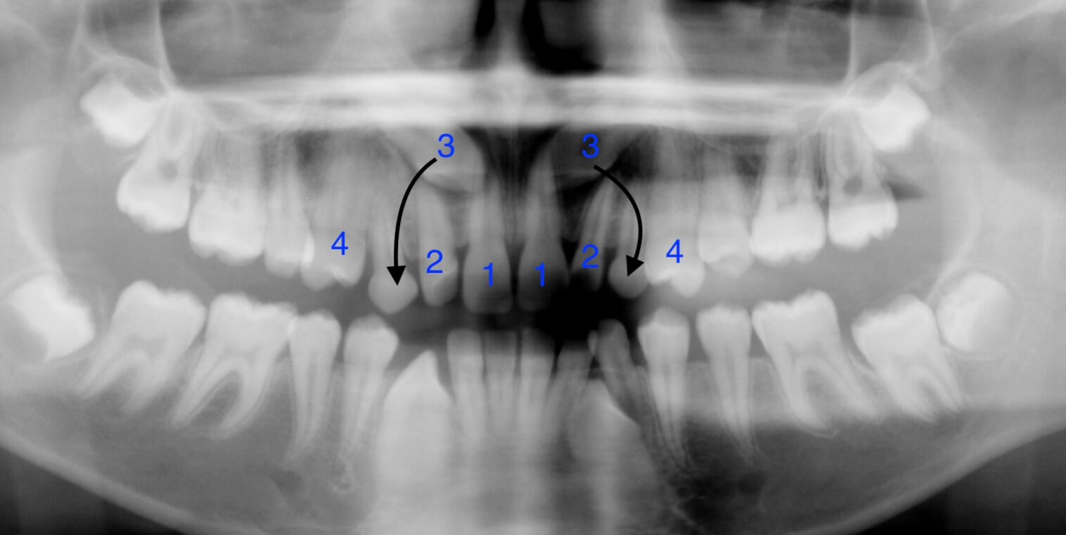 tooth-impactions-before2