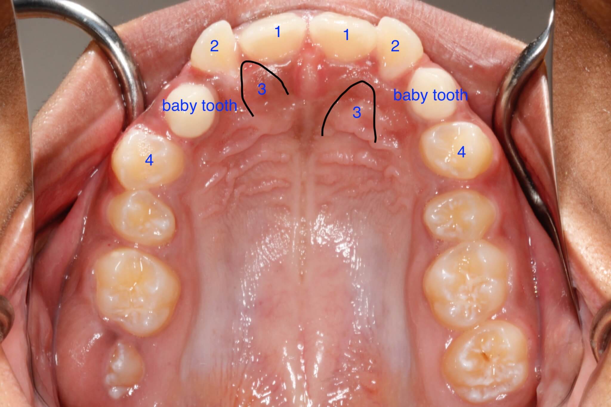 tooth-impactions-before3