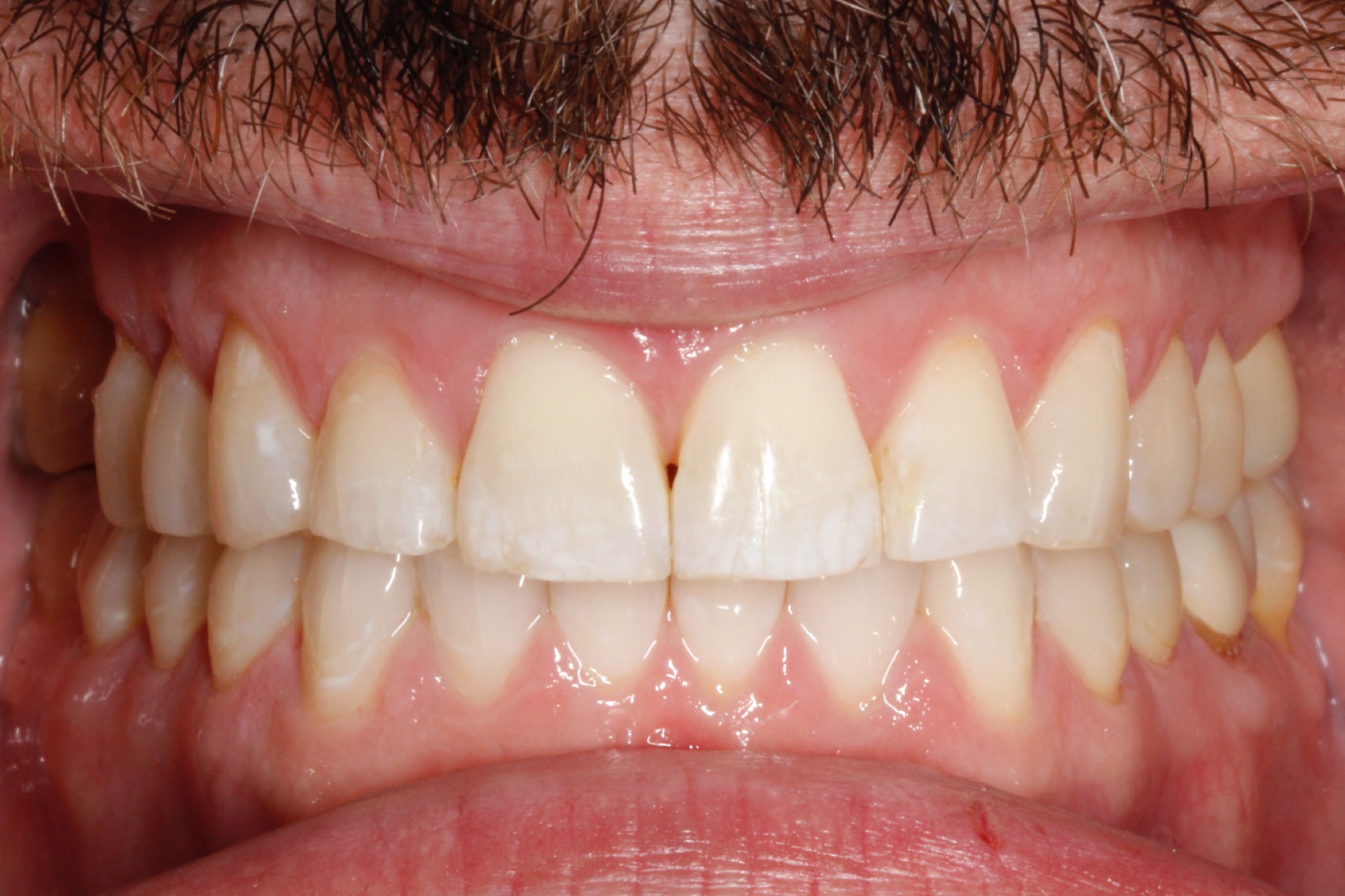 Invisalign6-after