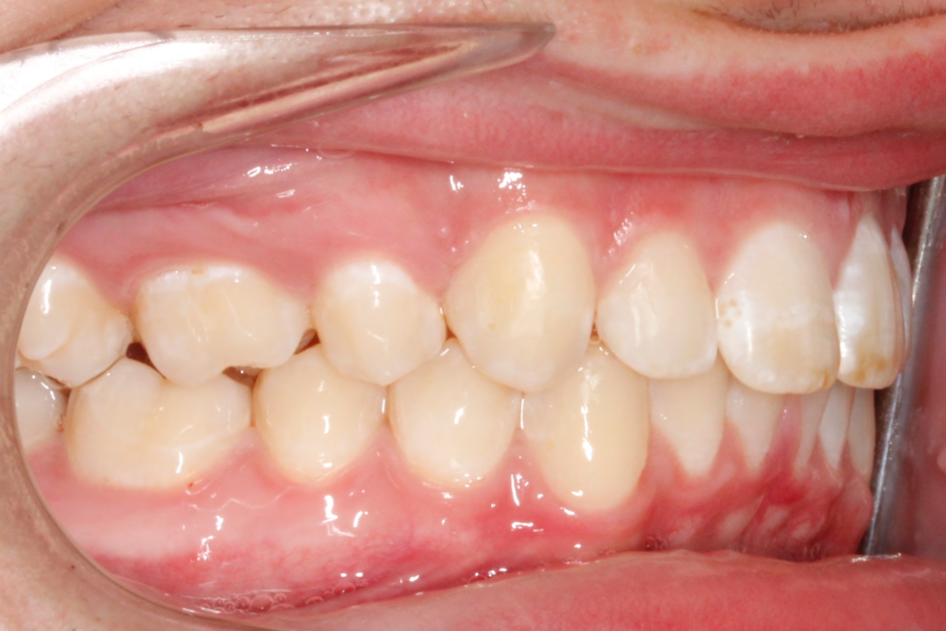 Invisalign7-after