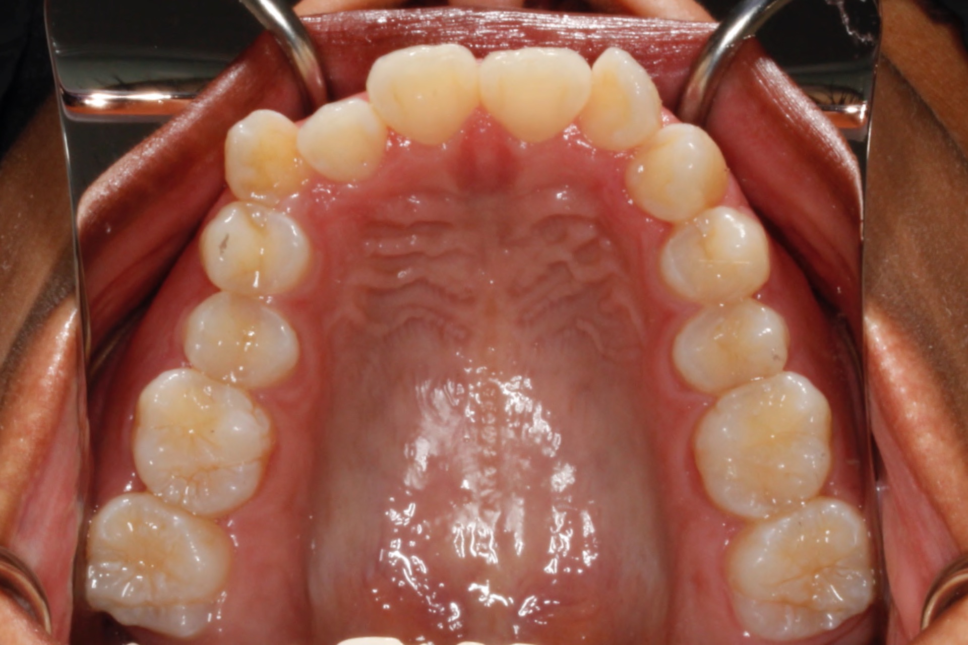 dental-crowding4