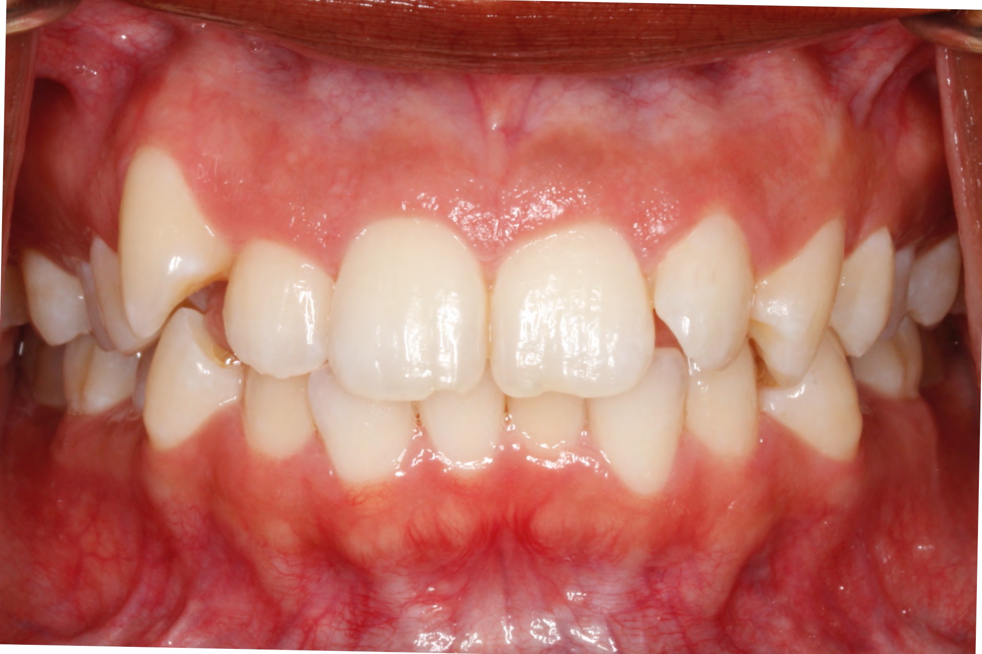 dental-crowding5