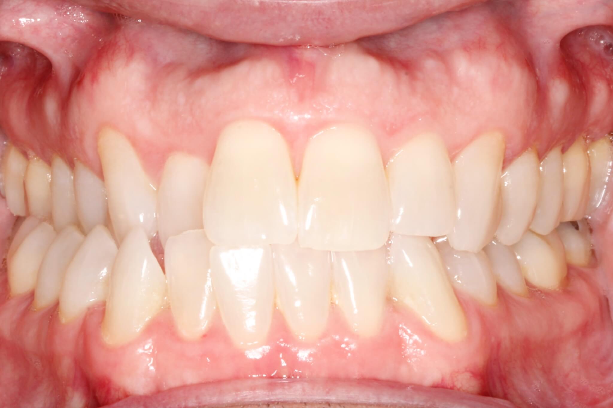 invisalign-after