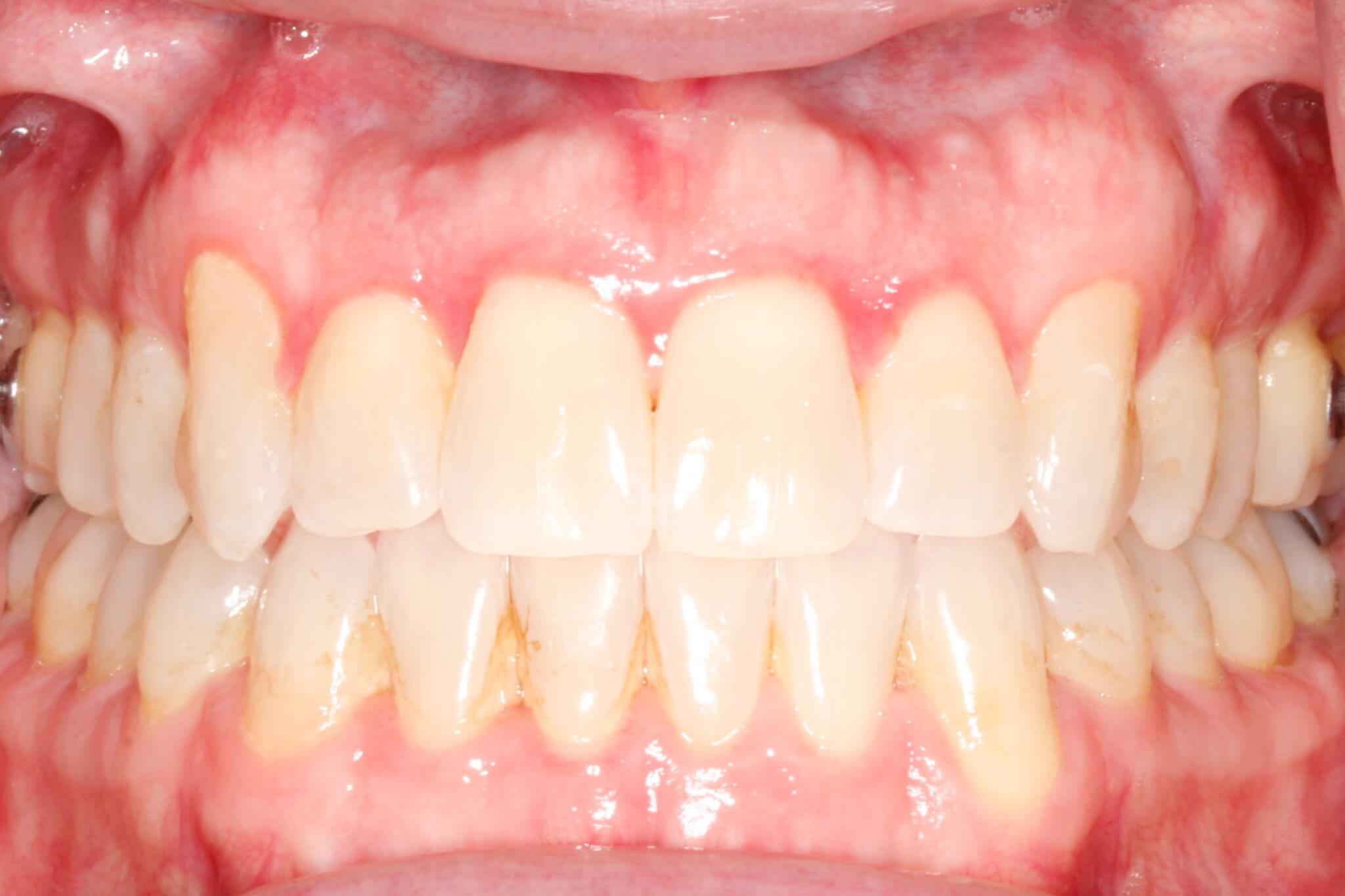 invisalign