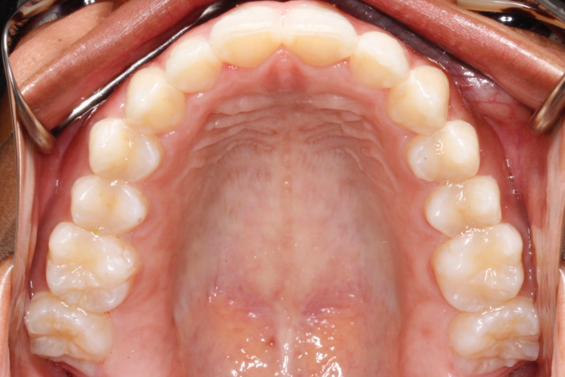 invisalign10-after