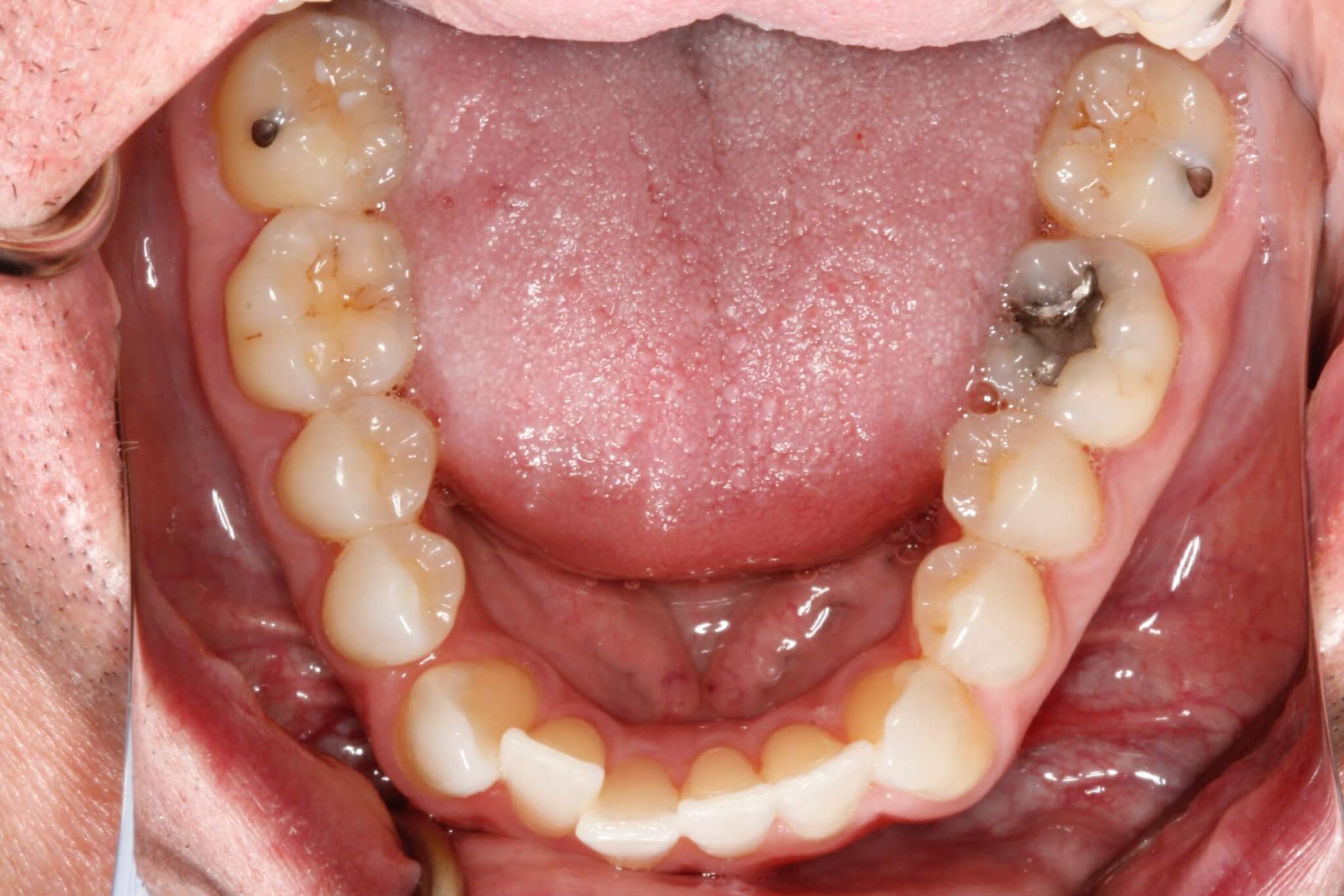 invisalign3