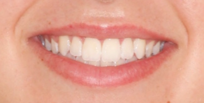 invisalign5-after