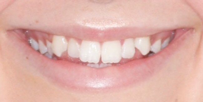 invisalign5