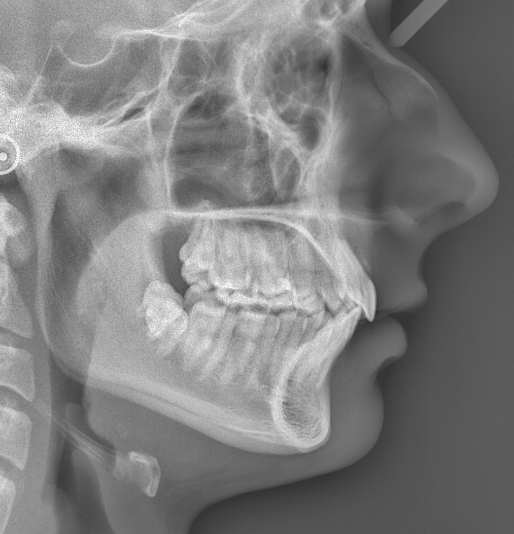 invisalign8-after