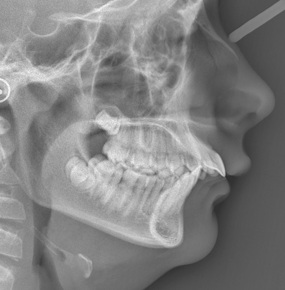 invisalign8
