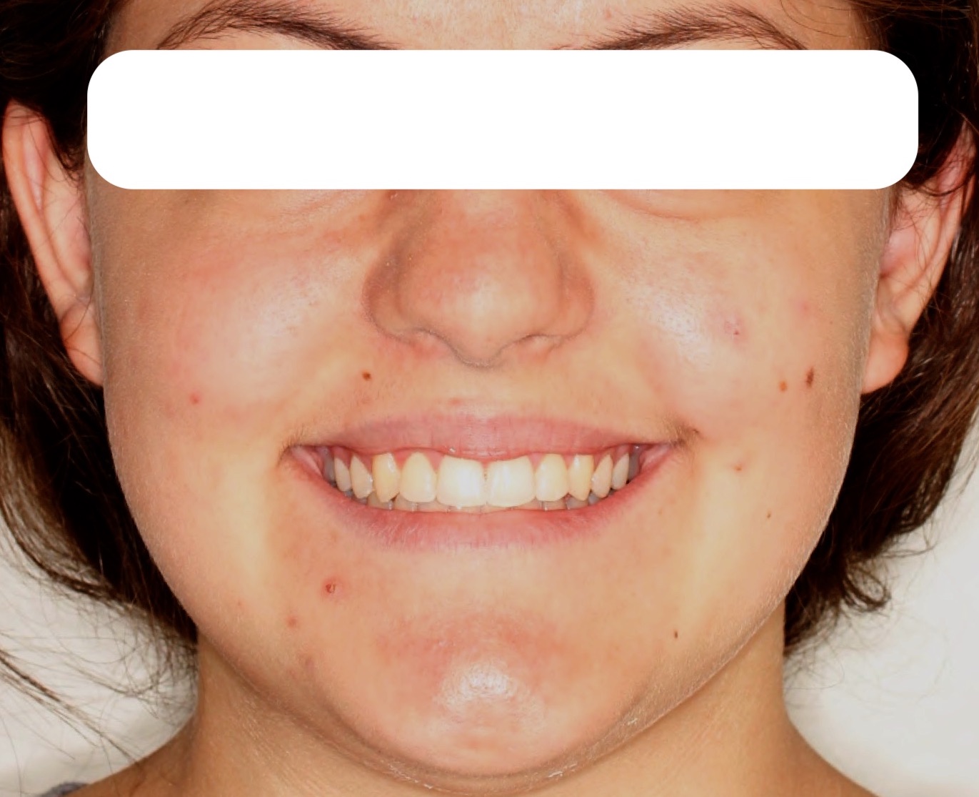 mecc3-after