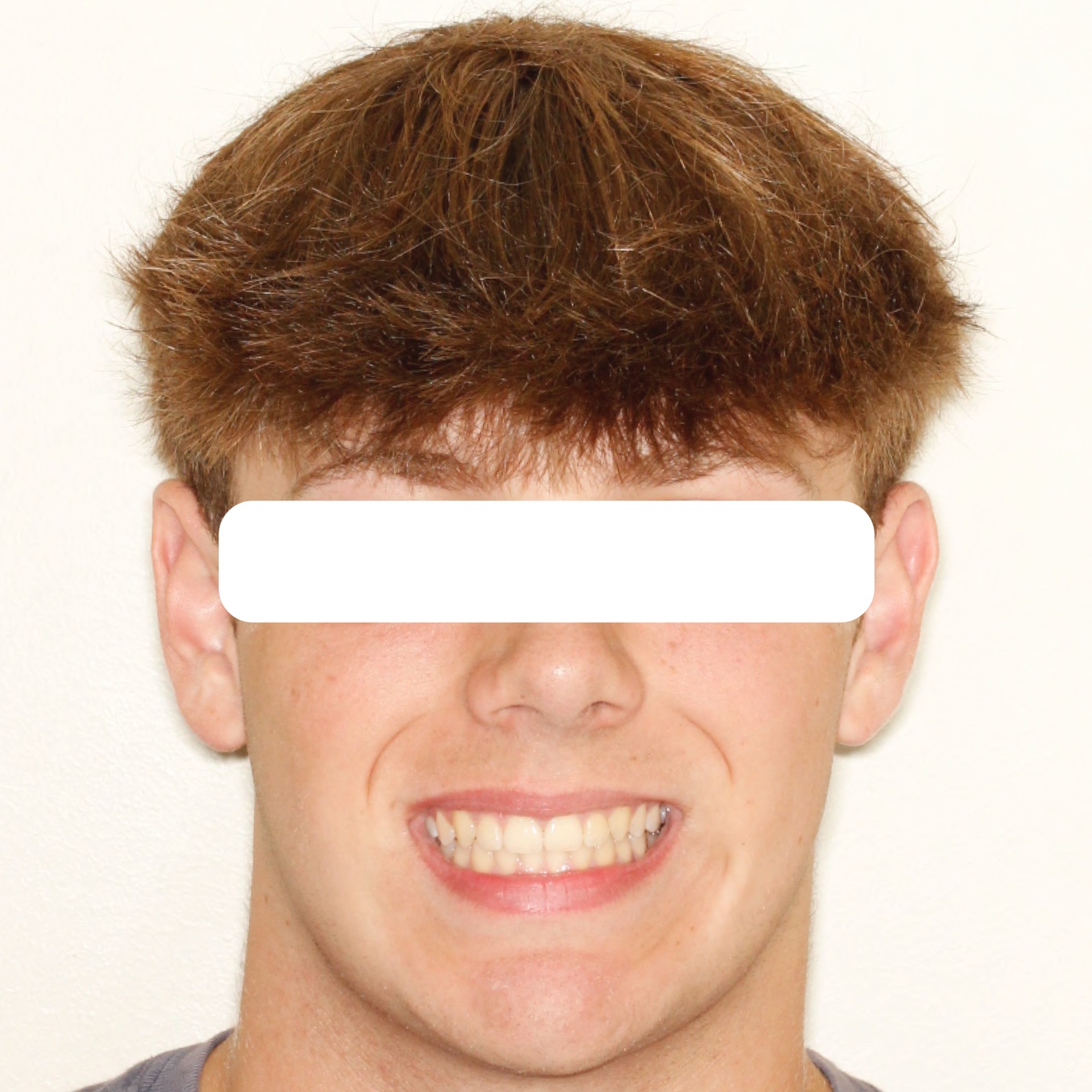 smile4-after