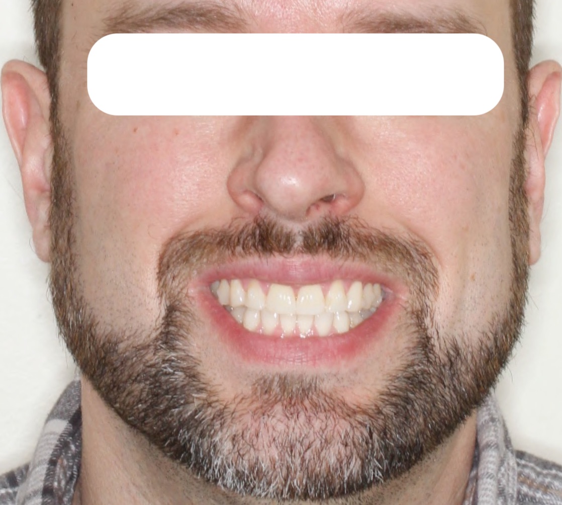 smile5-after