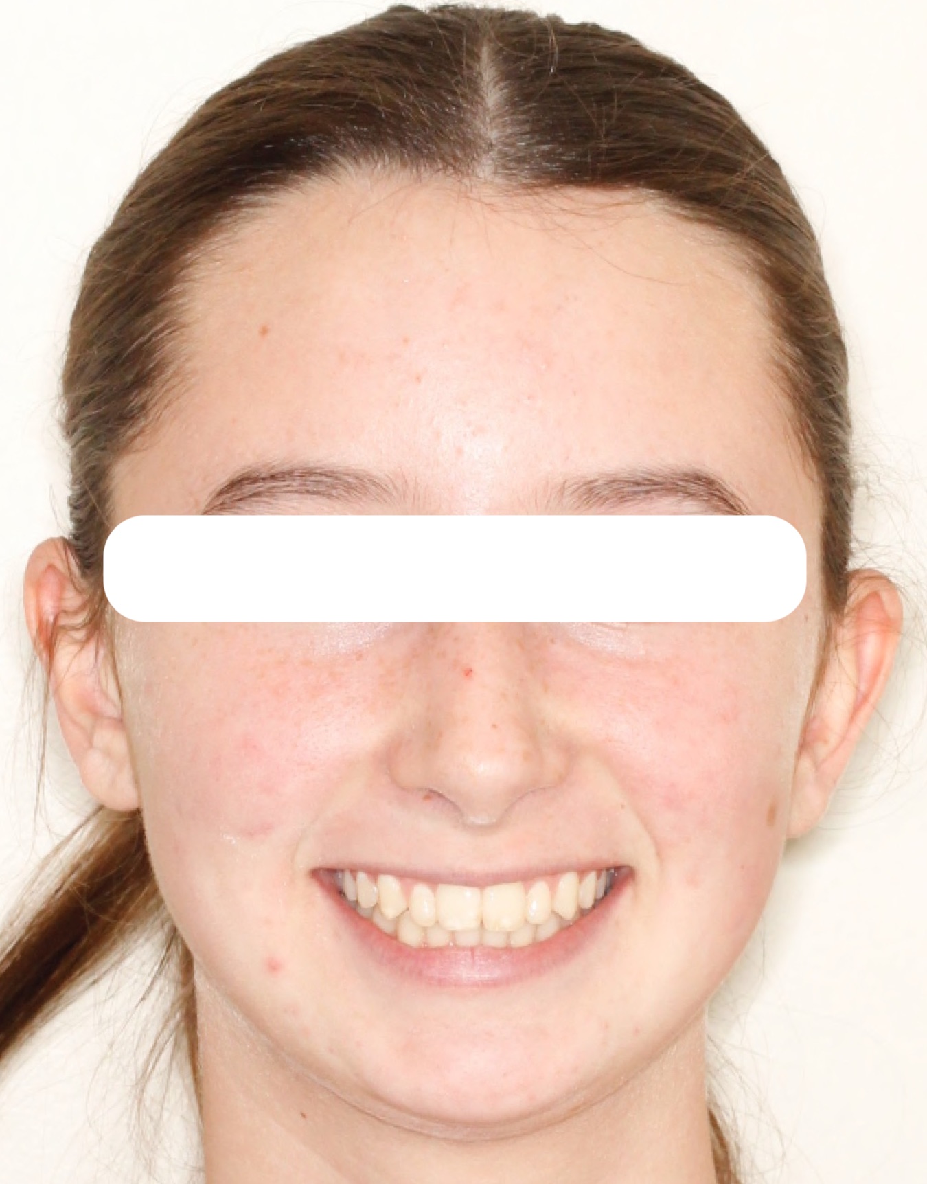 smile6-after