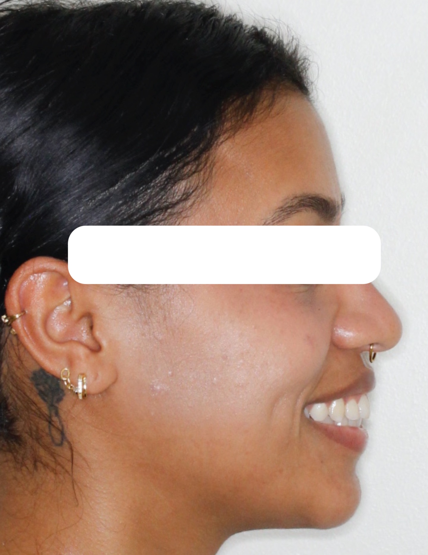 smile7-after