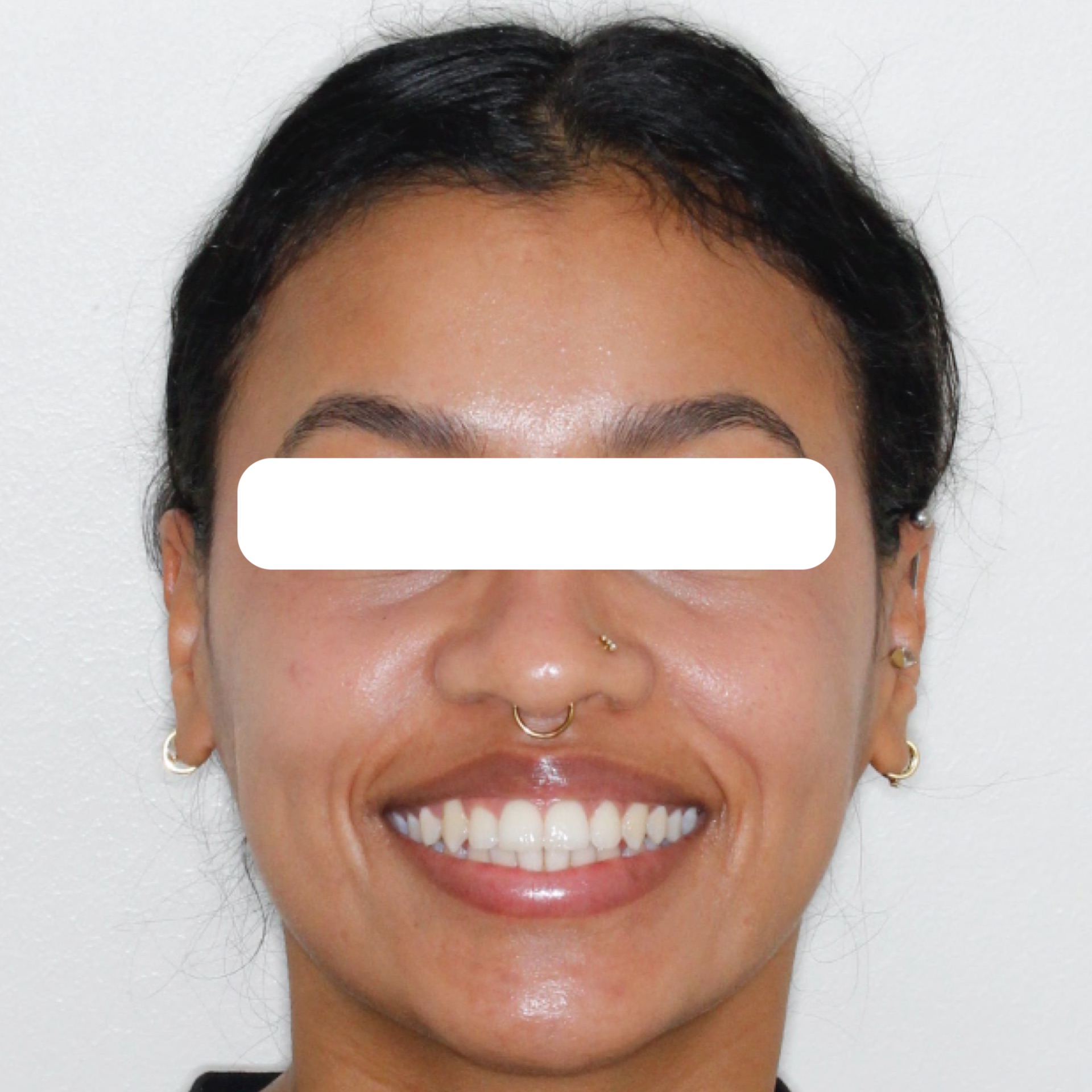 smile8-after